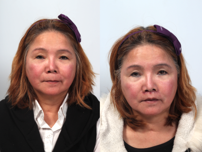 左圖是手術前，右圖是手術 後，縮人中手術後人中明顯變短，且唇型明顯。