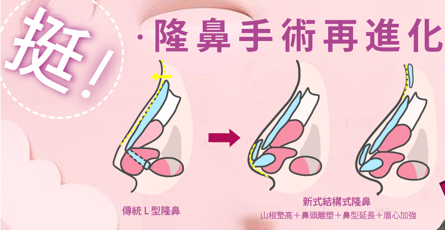 結構式隆鼻手術再進化