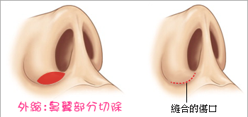 縮鼻翼傷口隱藏在內側