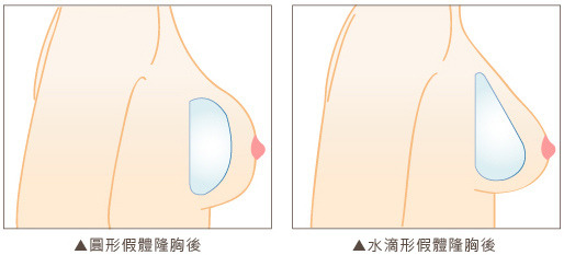 水滴形假體能給予胸部更自然的圓潤