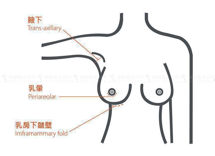 魔滴隆乳置入傷口位置