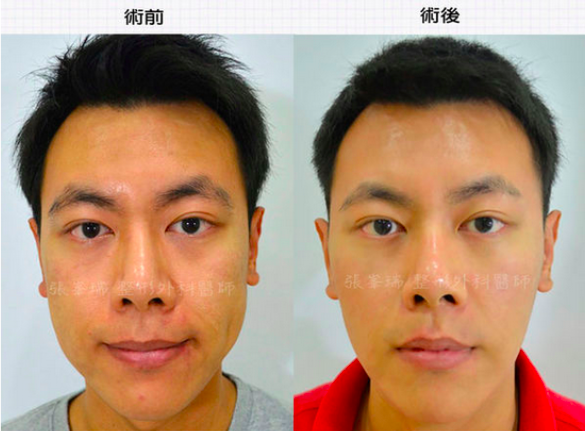 臉部埋線療程可以改善初老的臉部鬆弛，消除嘴邊⾁。