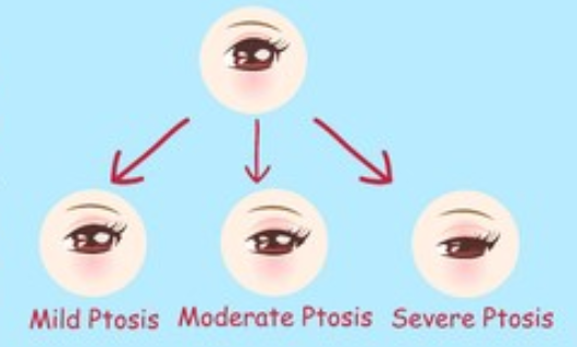 提眼肌無力不同程度