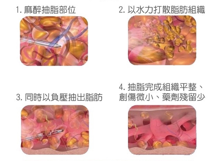 傳統抽脂VS.水刀抽脂和威塑抽脂